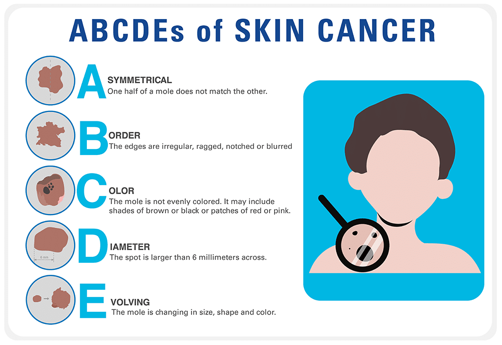 ABC's of skin cancer graphic