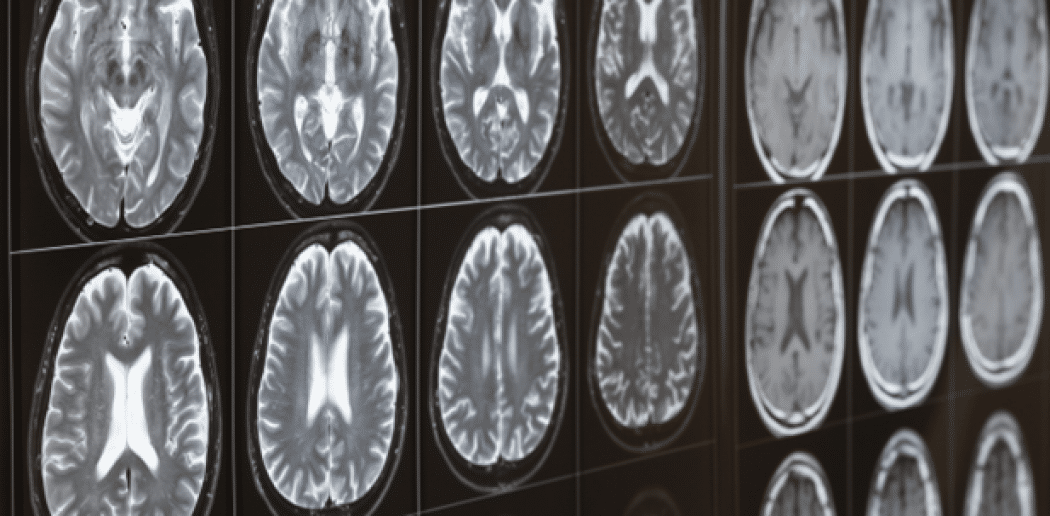 Spotting the Warning Signs of Stroke Critical for Successful Treatment