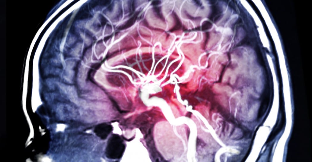 Aneurysm Awareness Month