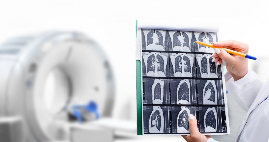 Lung Cancer Screening Saves Lives