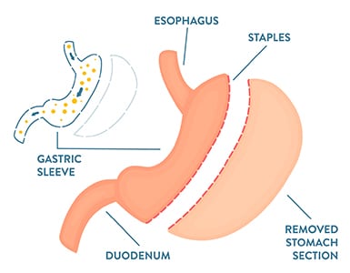 An illustration of gastric sleeve surgery.